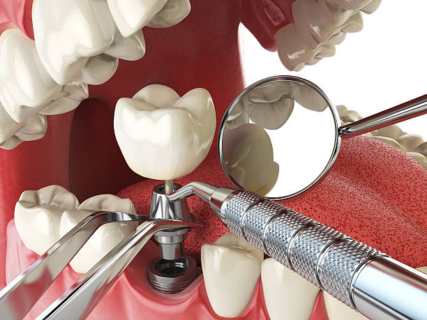 Best Broken or Chipped Tooth Repair in Rock Island, IL